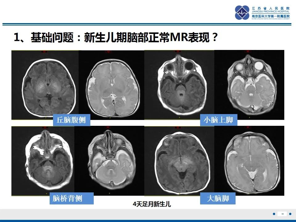 影像PPT - 【PPT】色素失禁症的影像表现-17