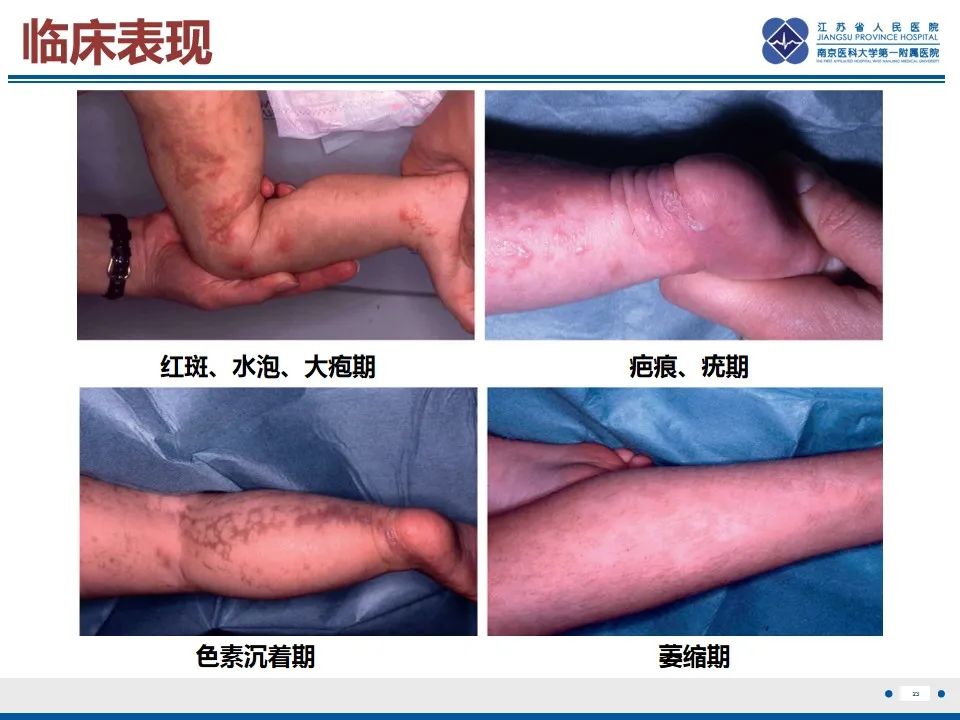 影像PPT - 【PPT】色素失禁症的影像表现-25