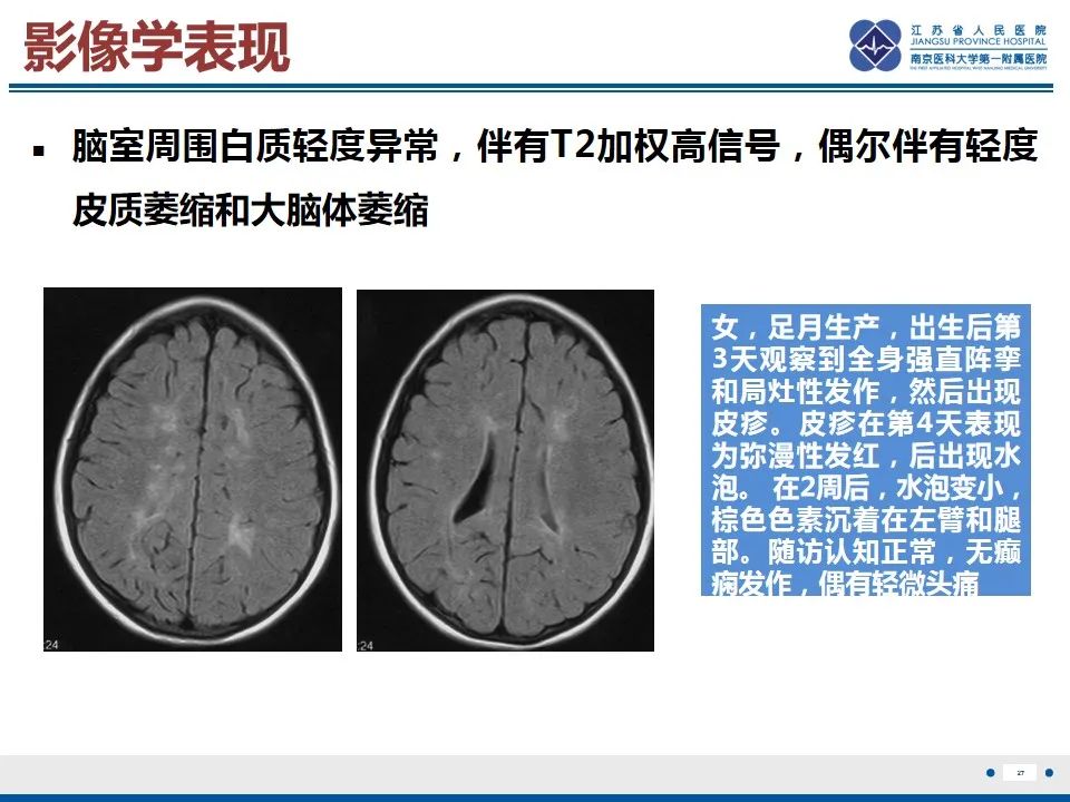 影像PPT - 【PPT】色素失禁症的影像表现-29