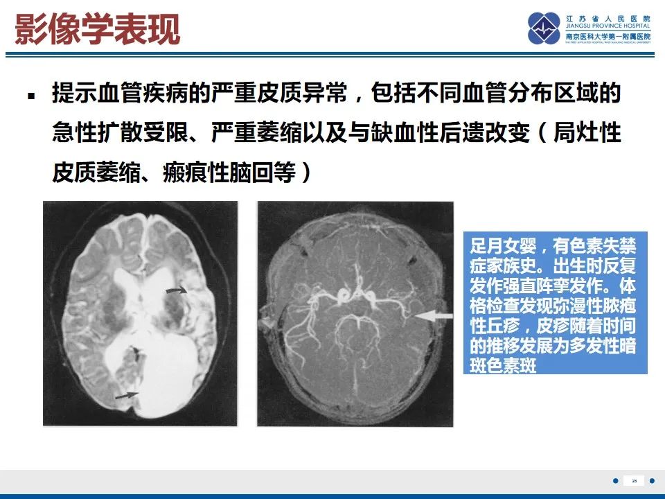 影像PPT - 【PPT】色素失禁症的影像表现-30