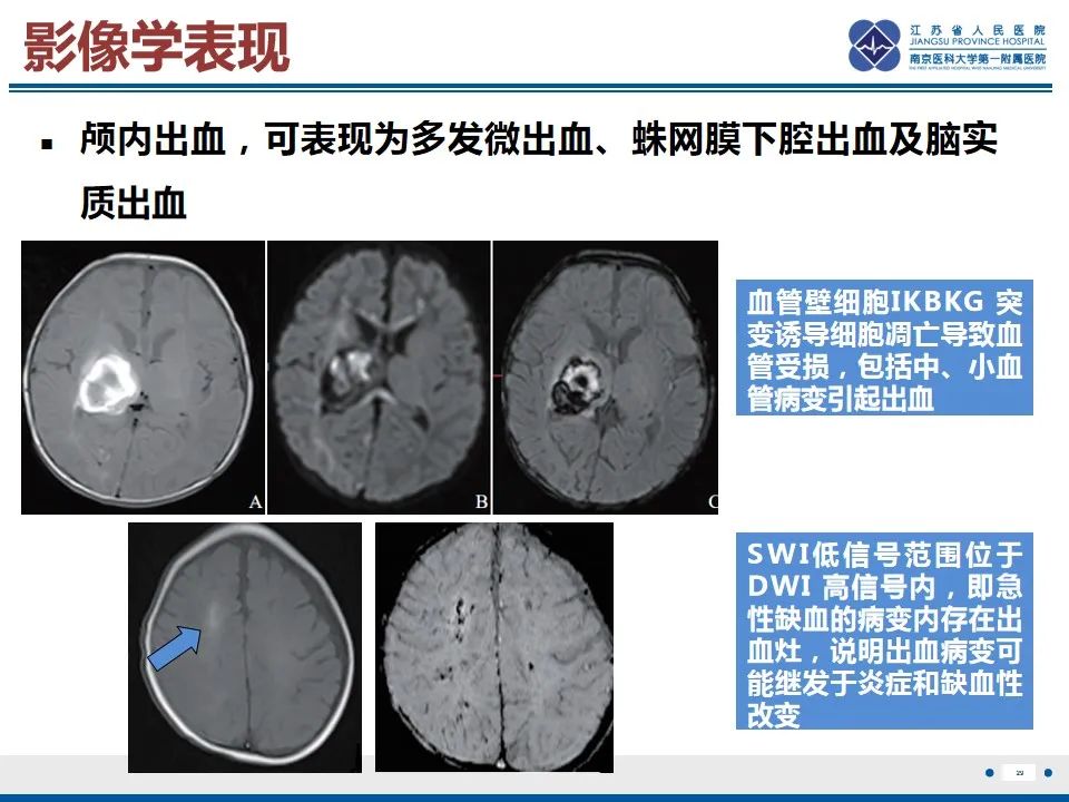 影像PPT - 【PPT】色素失禁症的影像表现-31