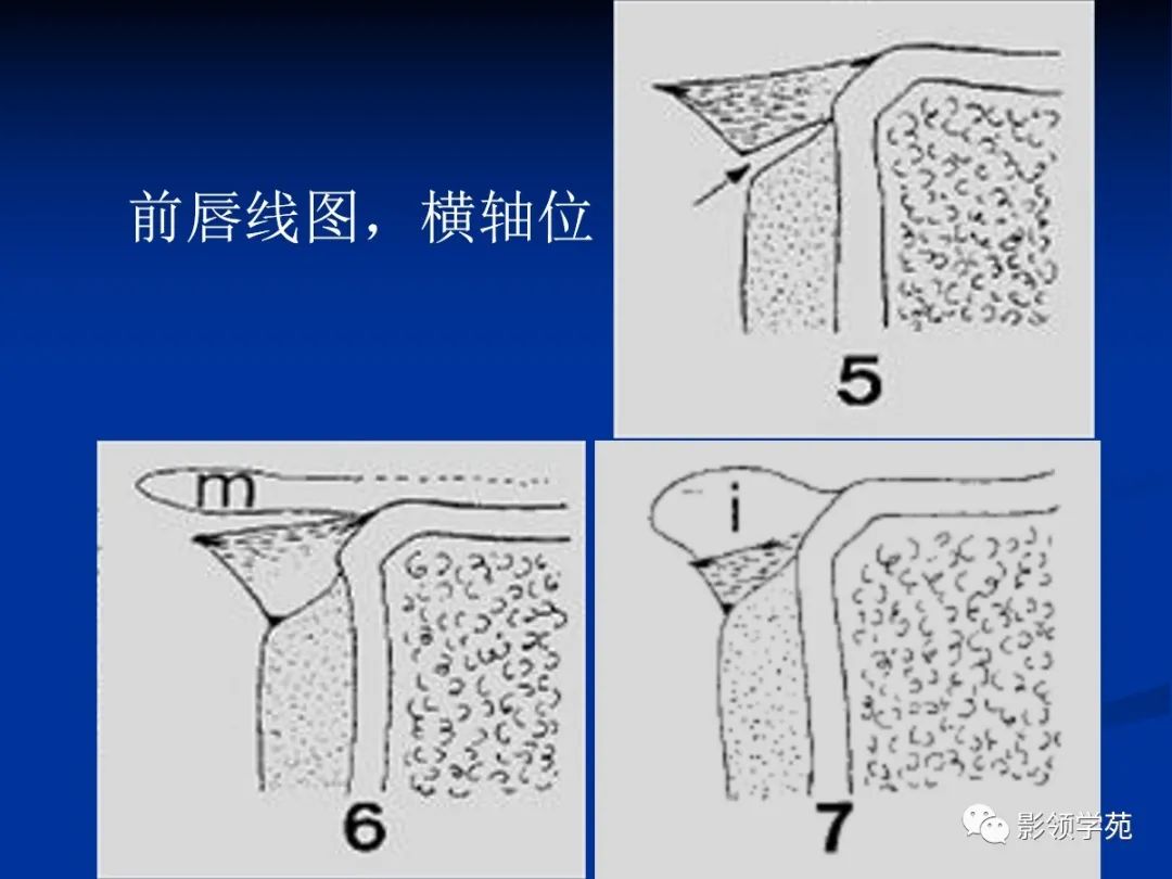 影像PPT - 【PPT】肩关节盂唇损伤的MRI诊断-7 影像PPT - 【PPT】肩关节盂唇损伤的MRI诊断-7
