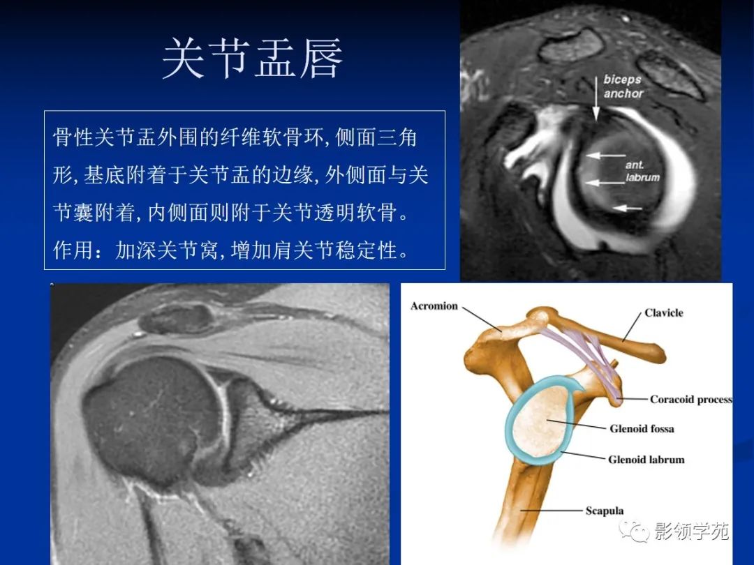 影像PPT - 【PPT】肩关节盂唇损伤的MRI诊断-8 影像PPT - 【PPT】肩关节盂唇损伤的MRI诊断-8