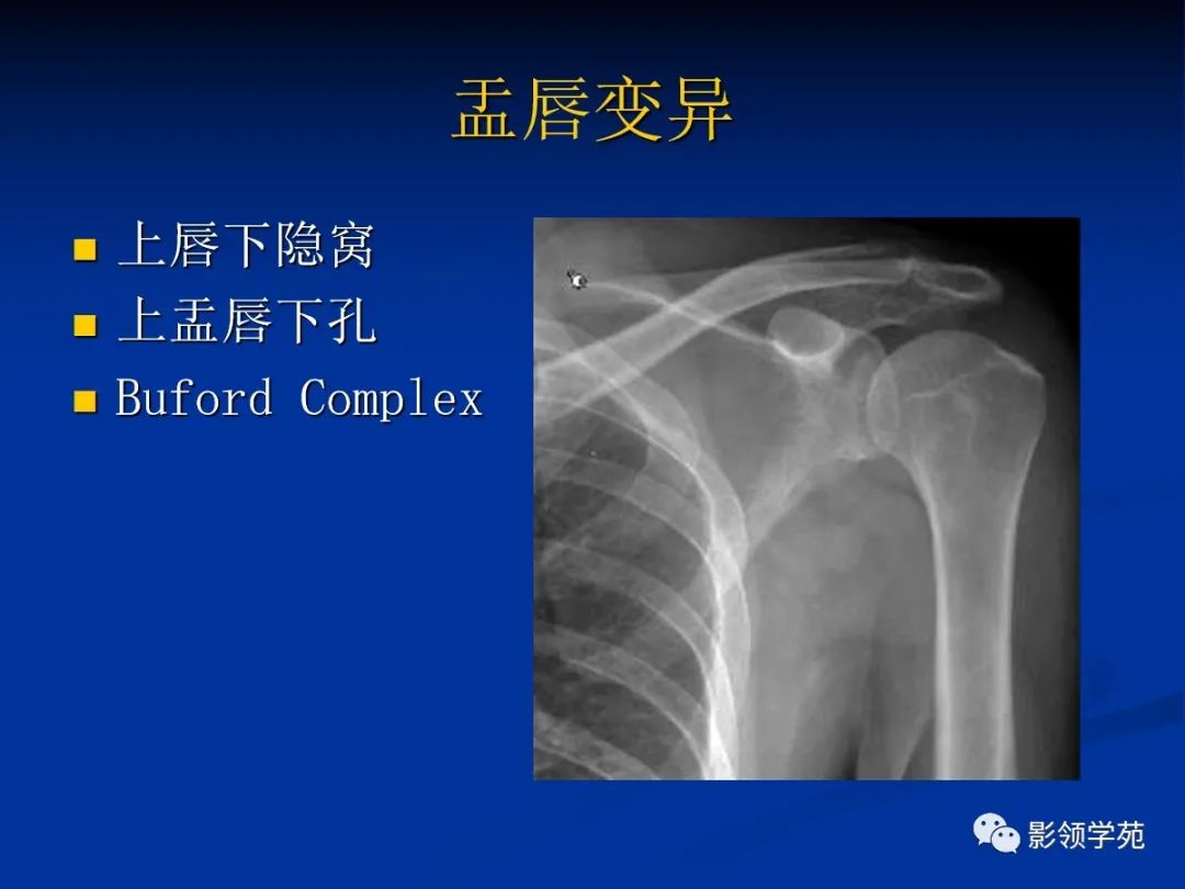 影像PPT - 【PPT】肩关节盂唇损伤的MRI诊断-10 影像PPT - 【PPT】肩关节盂唇损伤的MRI诊断-10