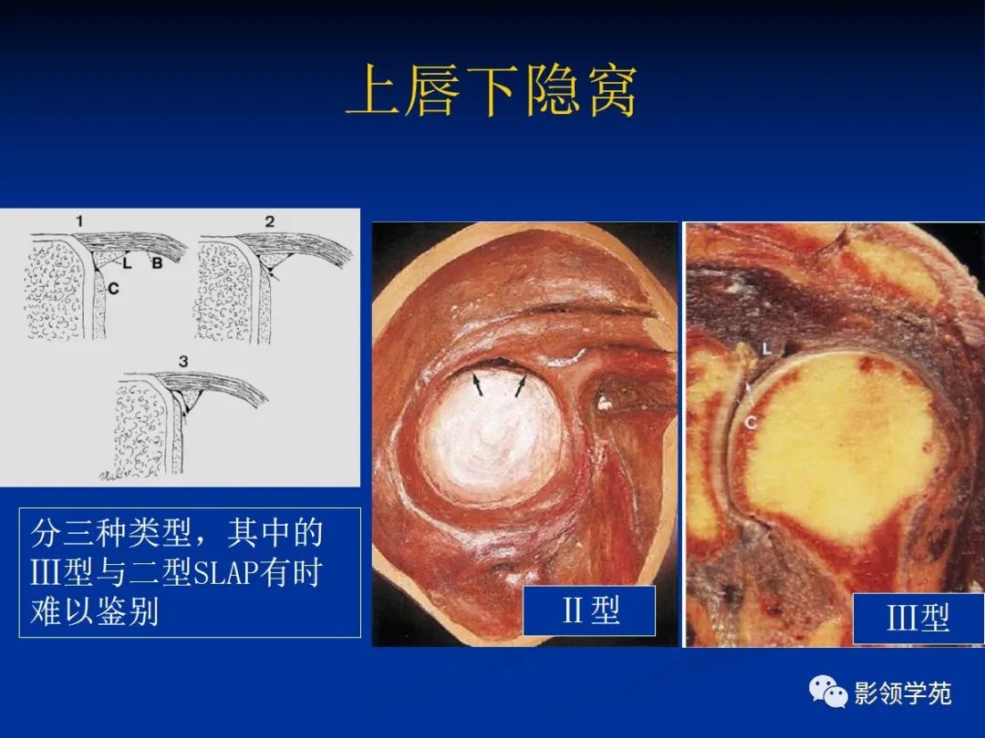 影像PPT - 【PPT】肩关节盂唇损伤的MRI诊断-11 影像PPT - 【PPT】肩关节盂唇损伤的MRI诊断-11