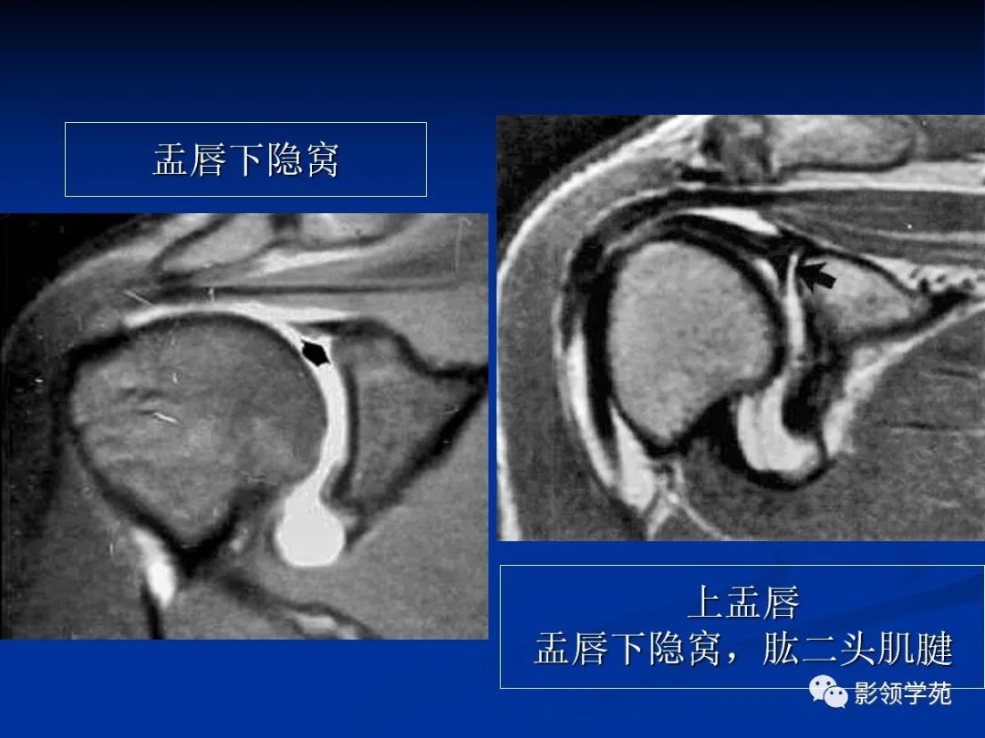 影像PPT - 【PPT】肩关节盂唇损伤的MRI诊断-13 影像PPT - 【PPT】肩关节盂唇损伤的MRI诊断-13