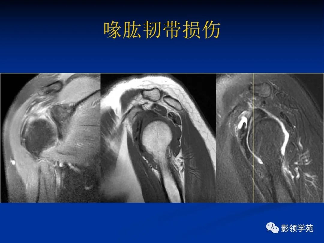 影像PPT - 【PPT】肩关节盂唇损伤的MRI诊断-24 影像PPT - 【PPT】肩关节盂唇损伤的MRI诊断-24