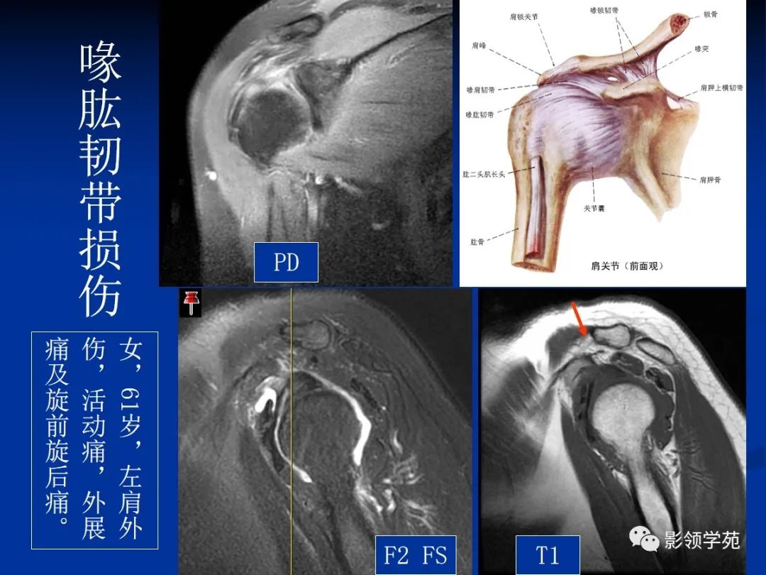 影像PPT - 【PPT】肩关节盂唇损伤的MRI诊断-25 影像PPT - 【PPT】肩关节盂唇损伤的MRI诊断-25