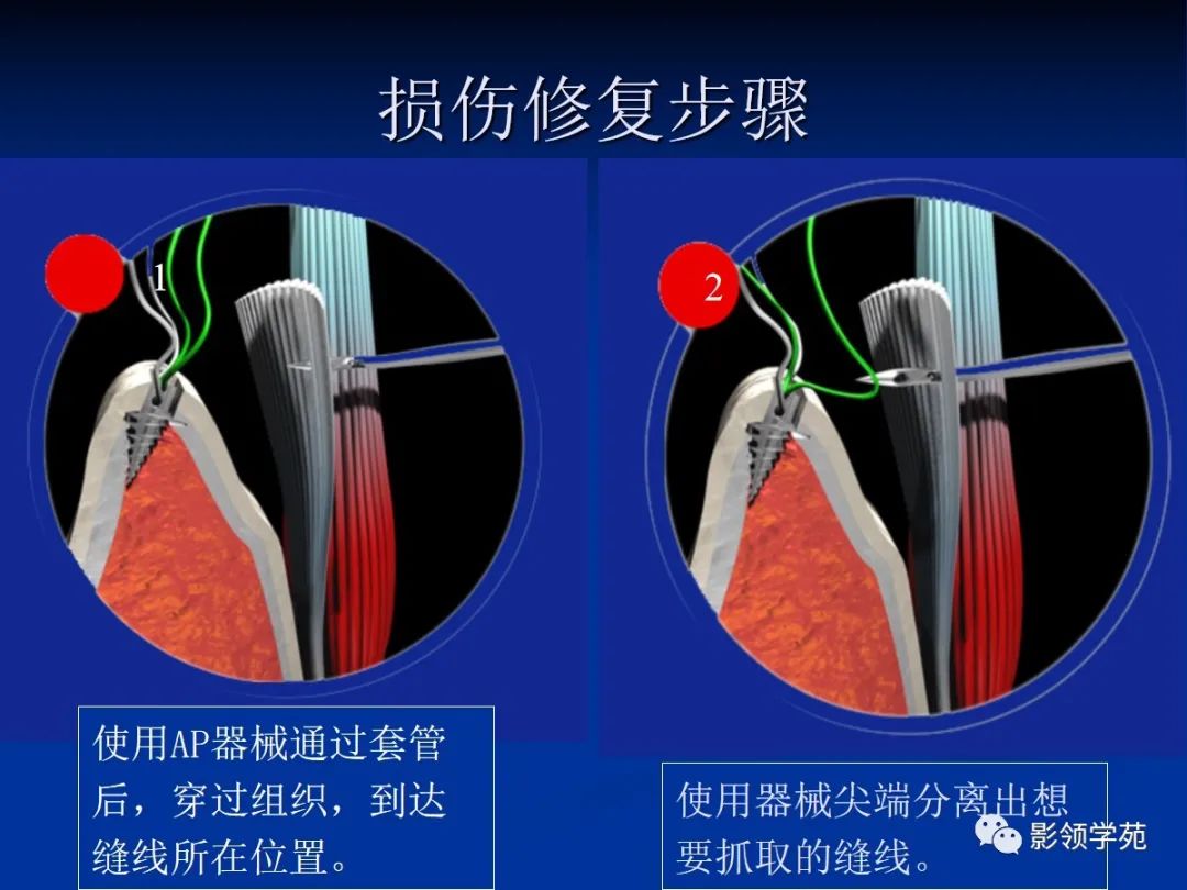 影像PPT - 【PPT】肩关节盂唇损伤的MRI诊断-29 影像PPT - 【PPT】肩关节盂唇损伤的MRI诊断-29
