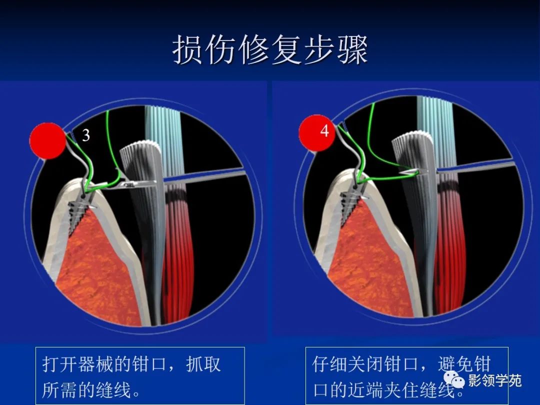 影像PPT - 【PPT】肩关节盂唇损伤的MRI诊断-30 影像PPT - 【PPT】肩关节盂唇损伤的MRI诊断-30