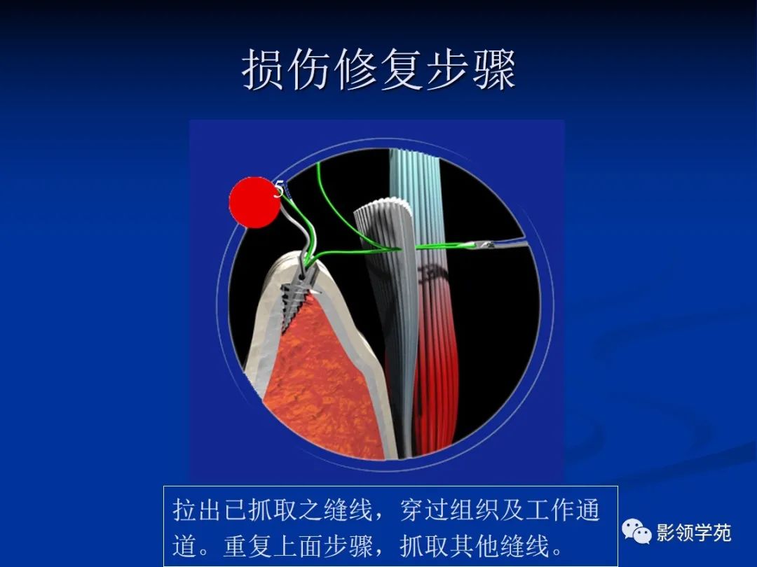 影像PPT - 【PPT】肩关节盂唇损伤的MRI诊断-31 影像PPT - 【PPT】肩关节盂唇损伤的MRI诊断-31