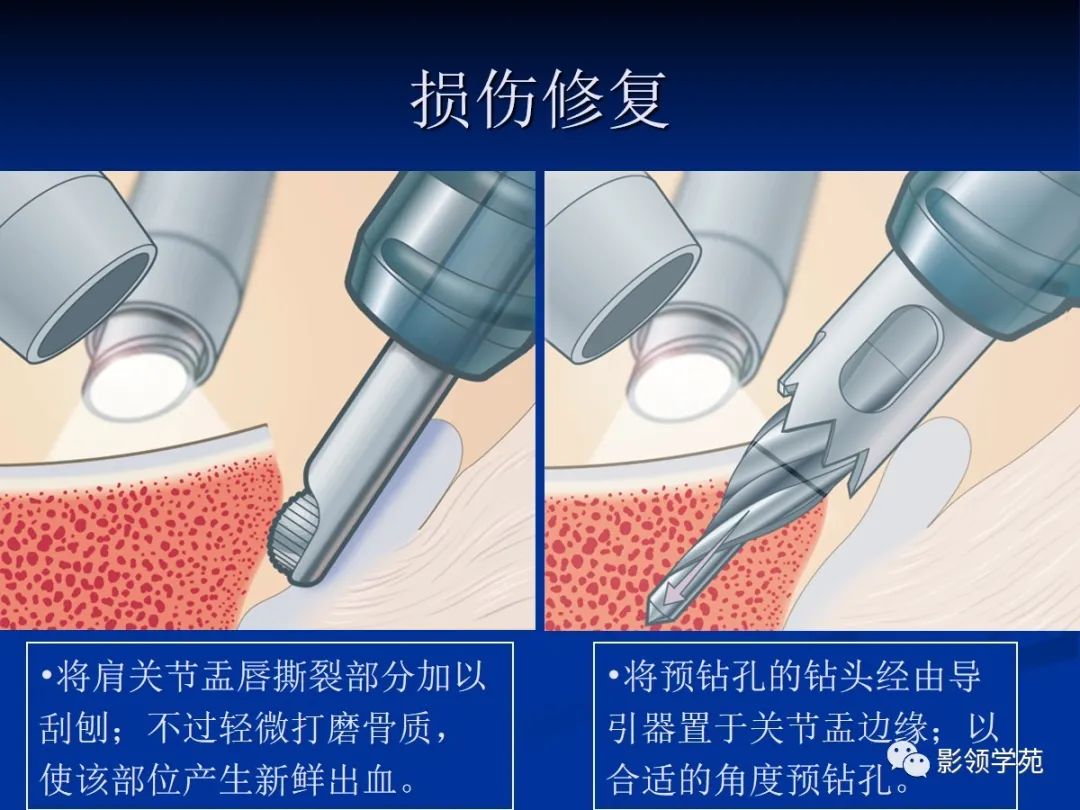 影像PPT - 【PPT】肩关节盂唇损伤的MRI诊断-32 影像PPT - 【PPT】肩关节盂唇损伤的MRI诊断-32