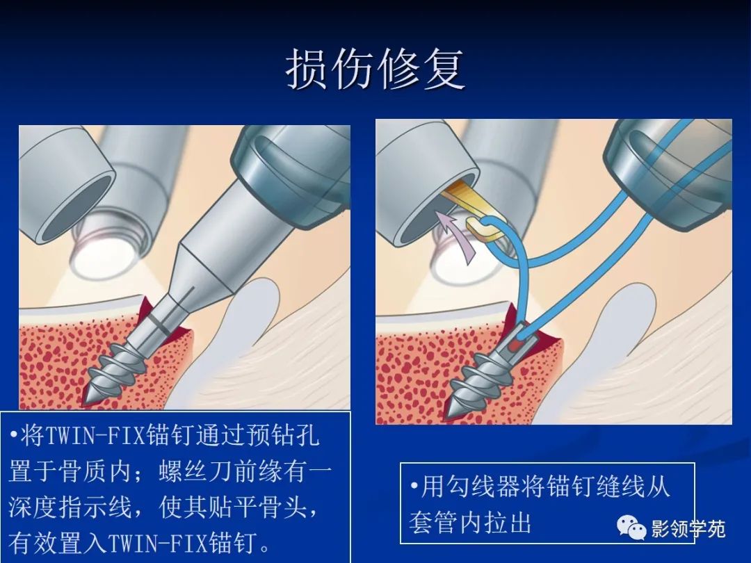 影像PPT - 【PPT】肩关节盂唇损伤的MRI诊断-33 影像PPT - 【PPT】肩关节盂唇损伤的MRI诊断-33