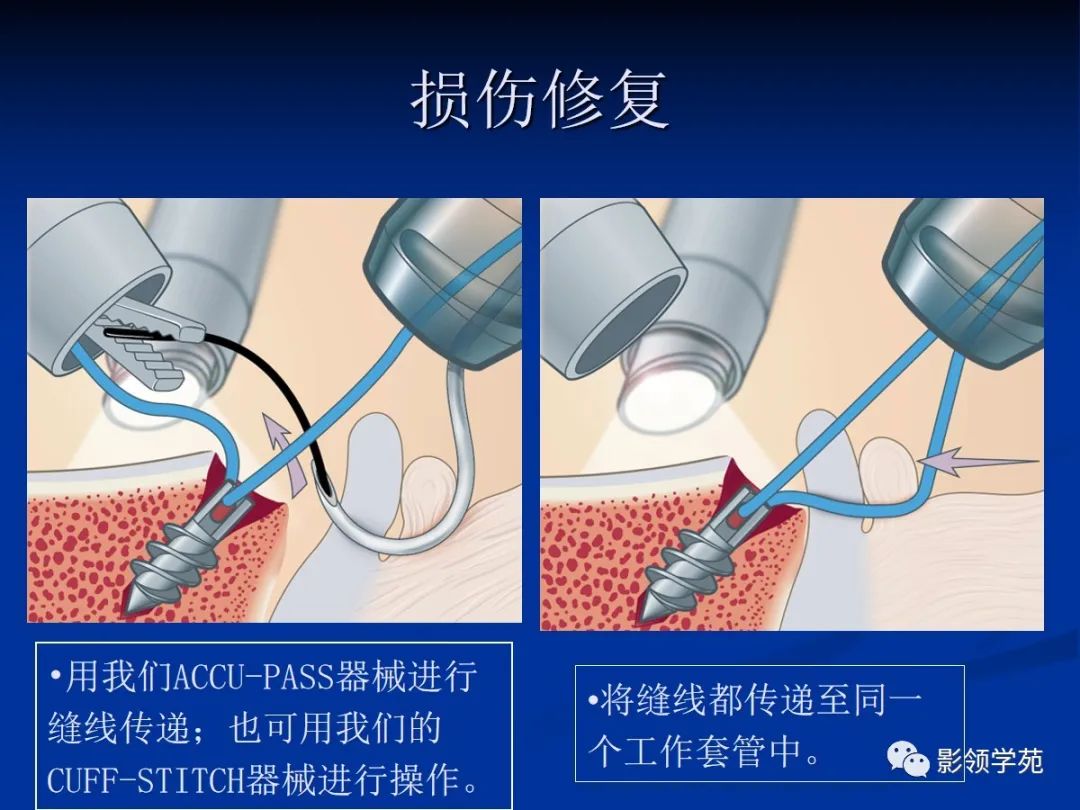影像PPT - 【PPT】肩关节盂唇损伤的MRI诊断-34 影像PPT - 【PPT】肩关节盂唇损伤的MRI诊断-34