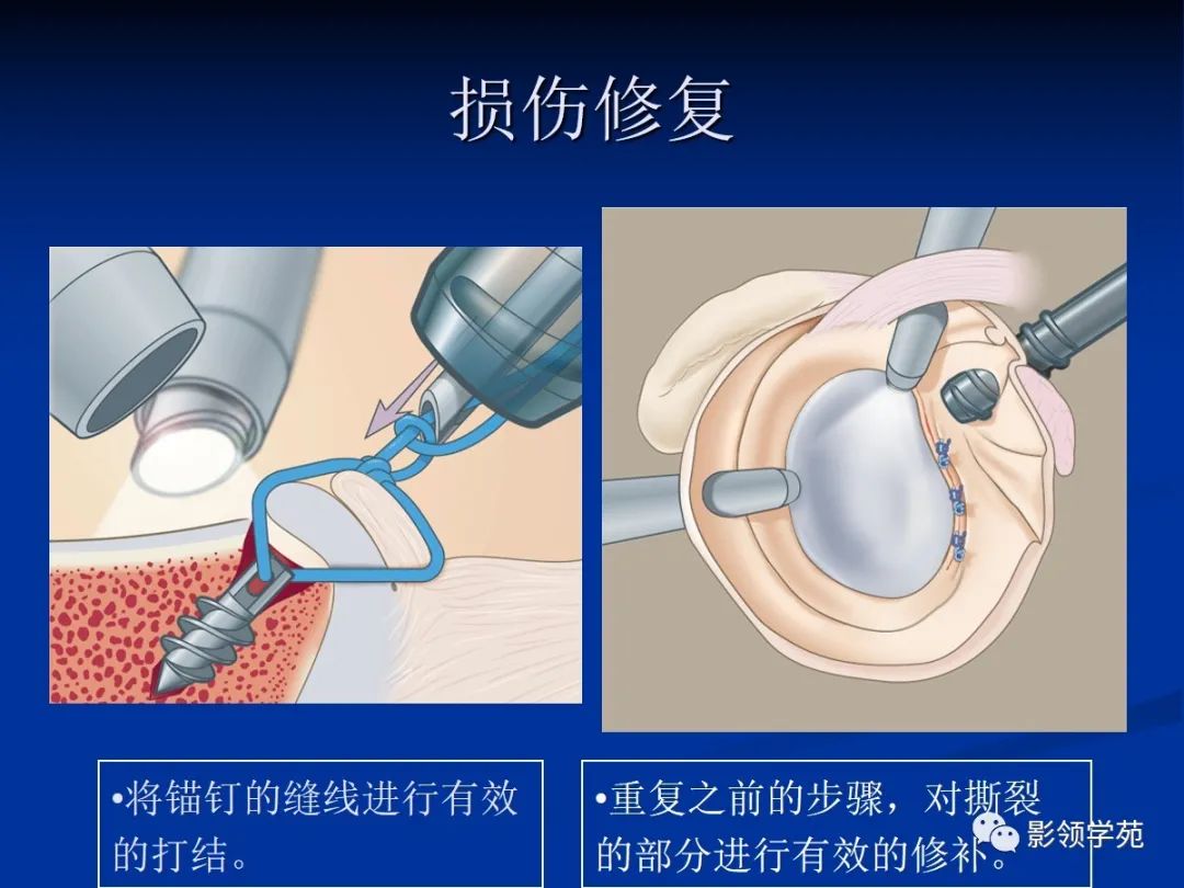 影像PPT - 【PPT】肩关节盂唇损伤的MRI诊断-35 影像PPT - 【PPT】肩关节盂唇损伤的MRI诊断-35