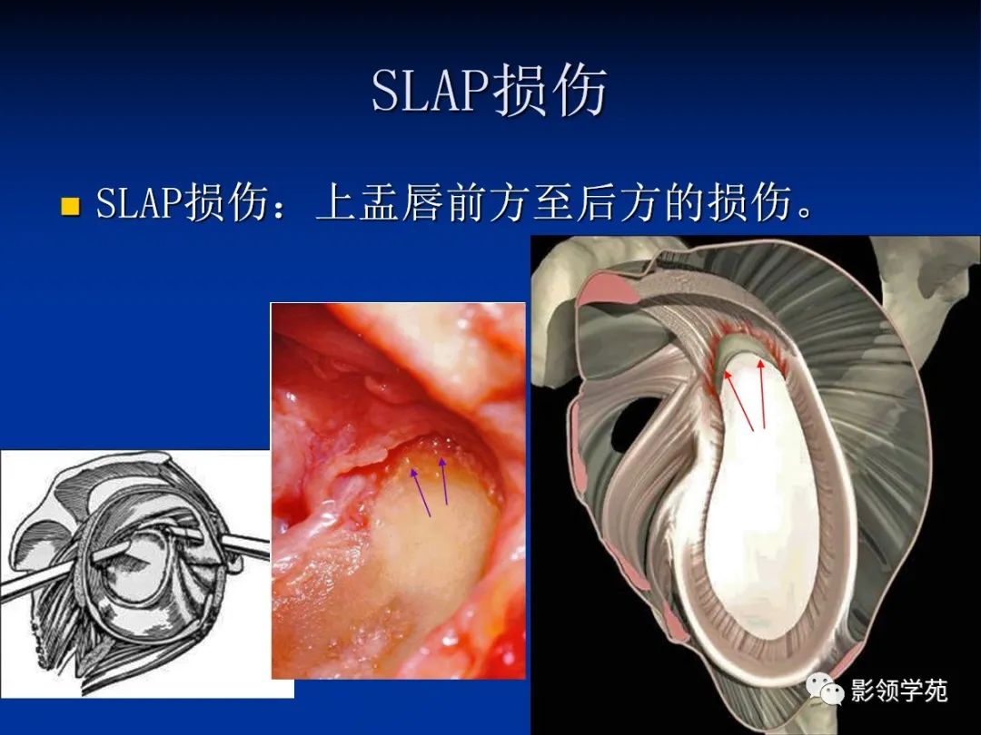 影像PPT - 【PPT】肩关节盂唇损伤的MRI诊断-38 影像PPT - 【PPT】肩关节盂唇损伤的MRI诊断-38