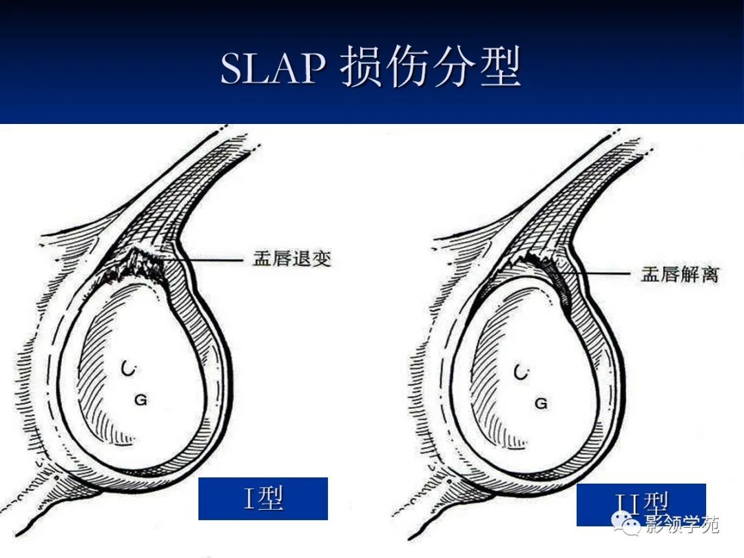影像PPT - 【PPT】肩关节盂唇损伤的MRI诊断-43 影像PPT - 【PPT】肩关节盂唇损伤的MRI诊断-43
