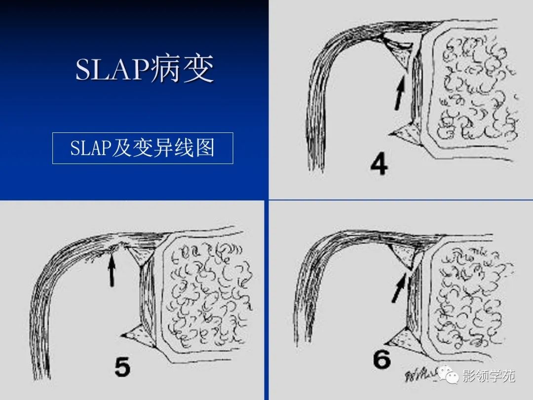 影像PPT - 【PPT】肩关节盂唇损伤的MRI诊断-42 影像PPT - 【PPT】肩关节盂唇损伤的MRI诊断-42