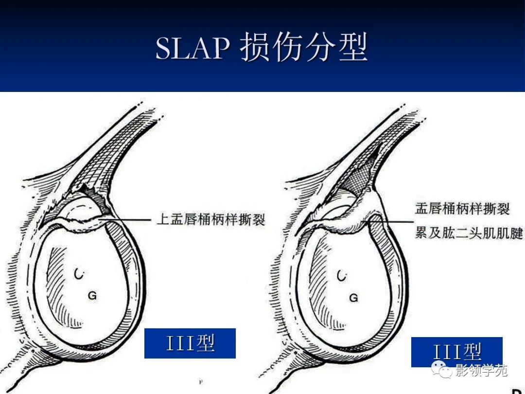 影像PPT - 【PPT】肩关节盂唇损伤的MRI诊断-44 影像PPT - 【PPT】肩关节盂唇损伤的MRI诊断-44