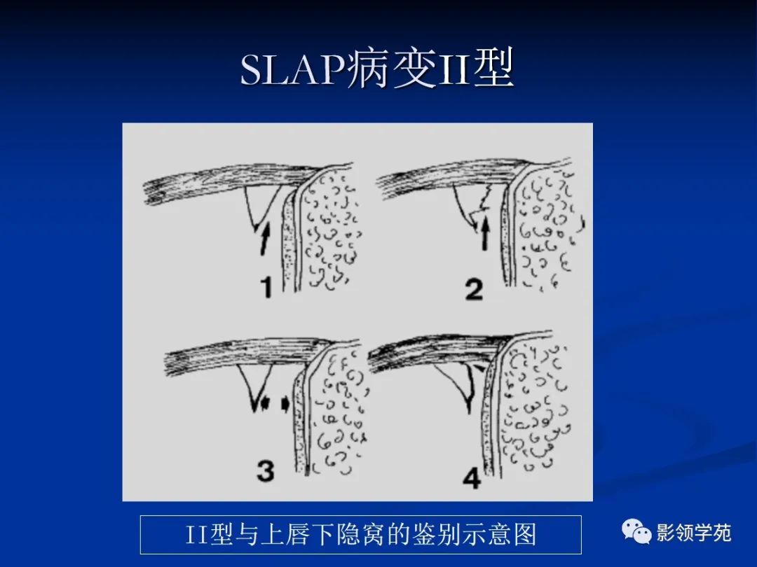影像PPT - 【PPT】肩关节盂唇损伤的MRI诊断-47 影像PPT - 【PPT】肩关节盂唇损伤的MRI诊断-47