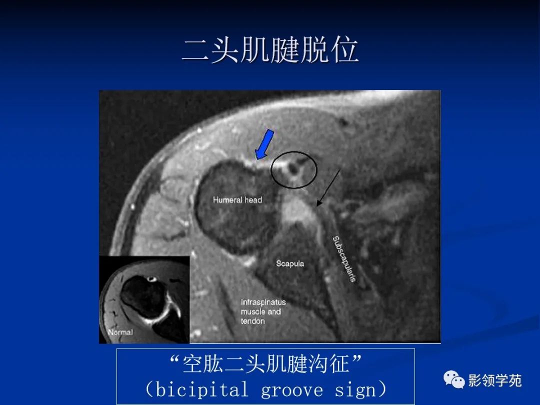 影像PPT - 【PPT】肩关节盂唇损伤的MRI诊断-65 影像PPT - 【PPT】肩关节盂唇损伤的MRI诊断-65