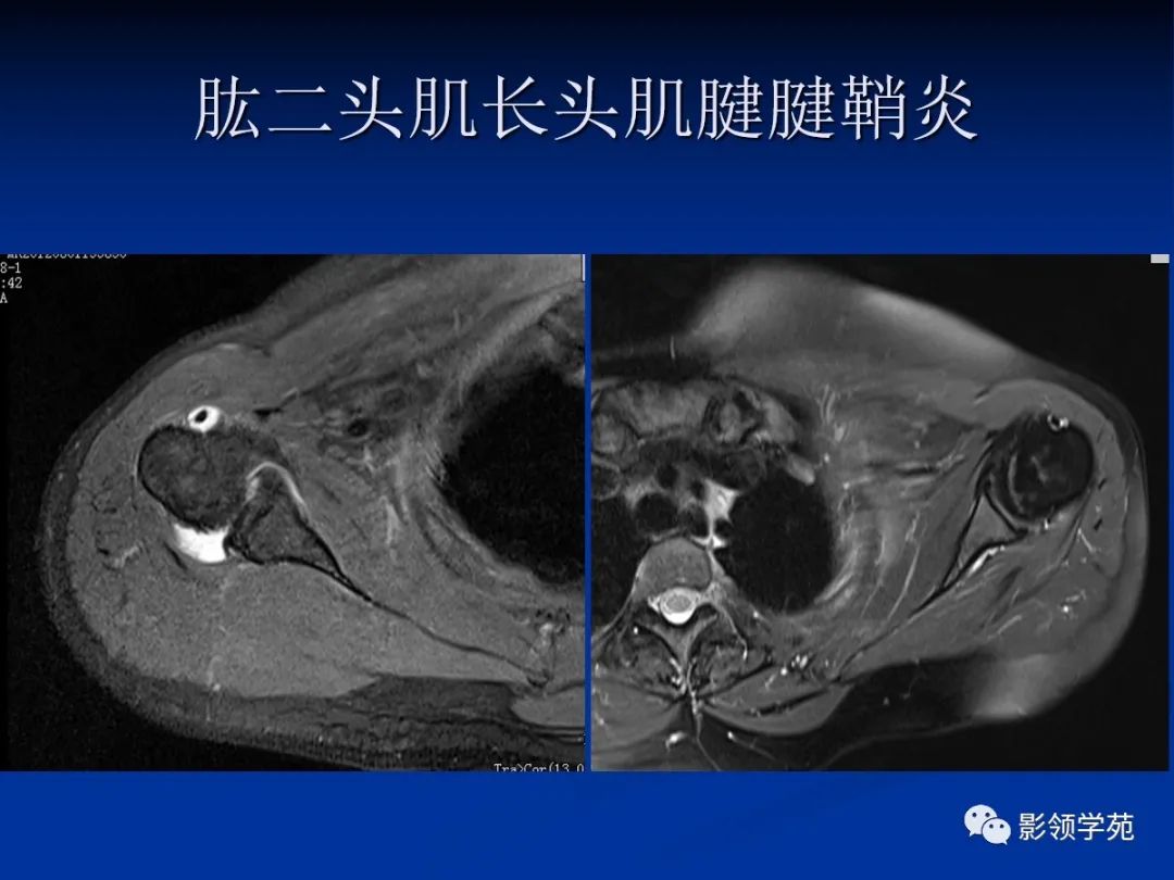 影像PPT - 【PPT】肩关节盂唇损伤的MRI诊断-64 影像PPT - 【PPT】肩关节盂唇损伤的MRI诊断-64