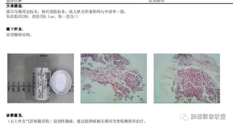 影像PPT - 【病例】肺结核还是肺癌?——善恶难辨-20 影像PPT - 【病例】肺结核还是肺癌?——善恶难辨-20