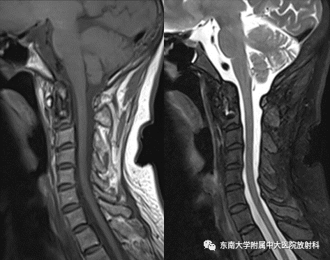 影像PPT - 【PPT】肾性骨营养不良-4 影像PPT - 【PPT】肾性骨营养不良-4