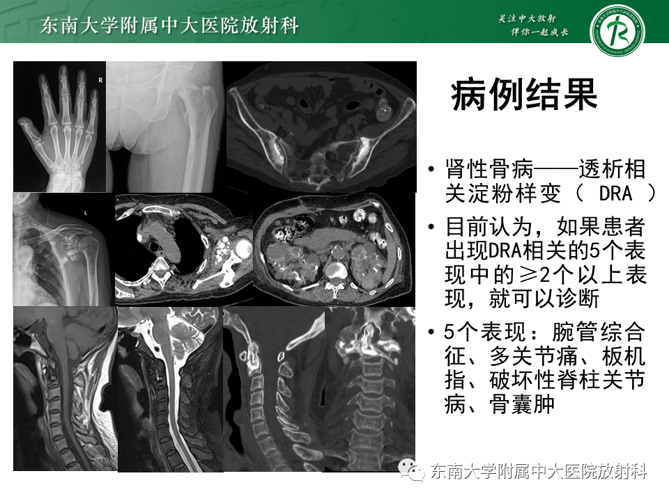 影像PPT - 【PPT】肾性骨营养不良-5 影像PPT - 【PPT】肾性骨营养不良-5