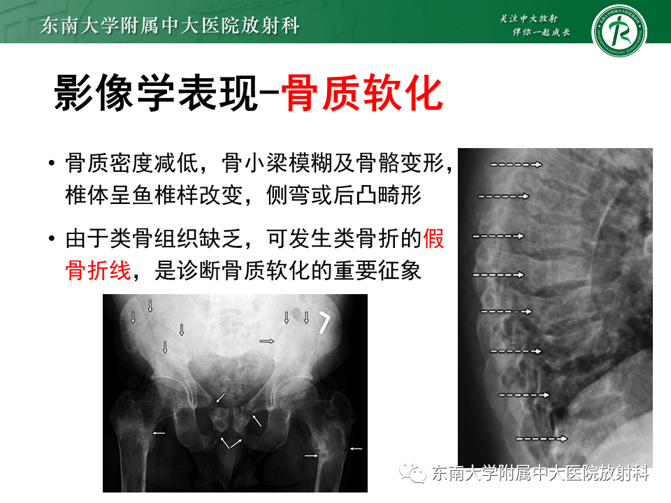 影像PPT - 【PPT】肾性骨营养不良-14 影像PPT - 【PPT】肾性骨营养不良-14