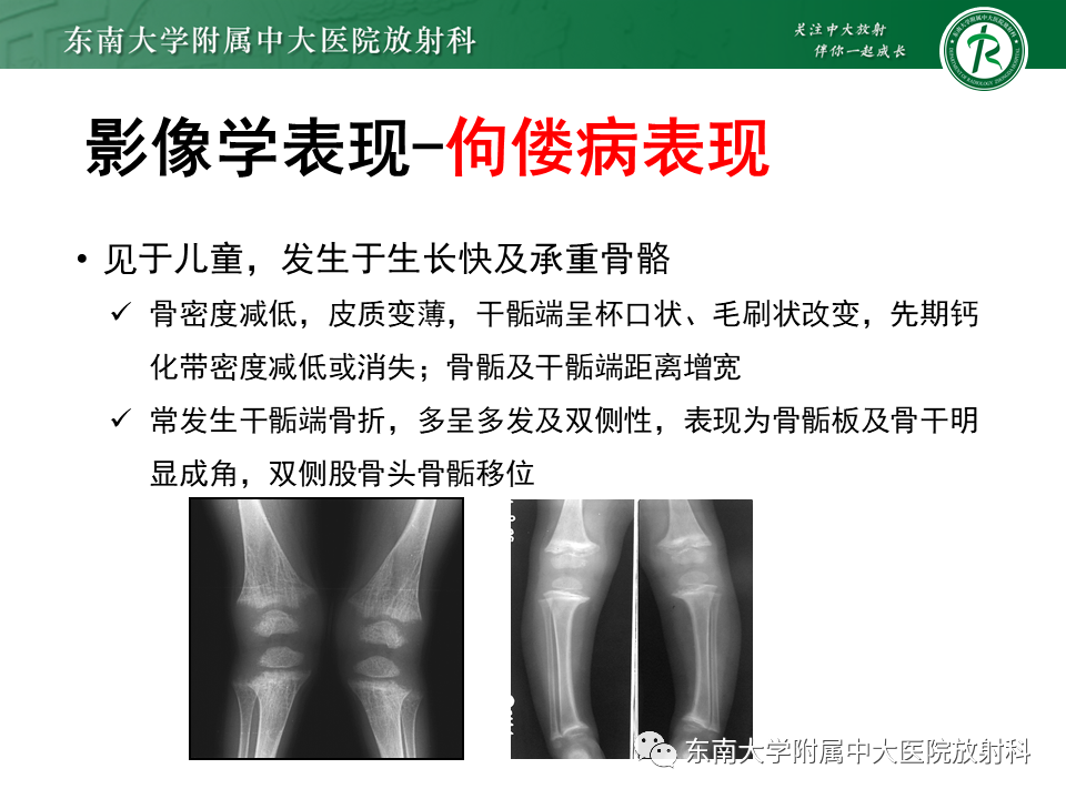 影像PPT - 【PPT】肾性骨营养不良-16 影像PPT - 【PPT】肾性骨营养不良-16