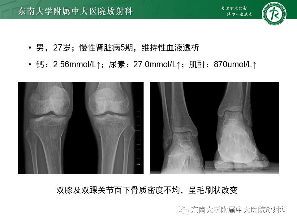 影像PPT - 【PPT】肾性骨营养不良-15 影像PPT - 【PPT】肾性骨营养不良-15