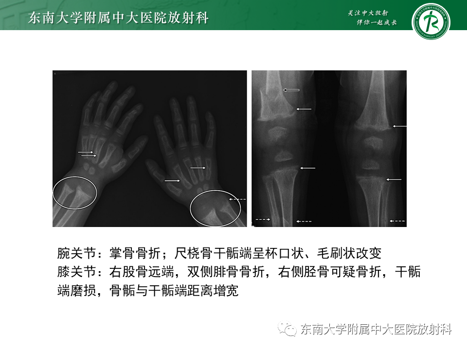 影像PPT - 【PPT】肾性骨营养不良-17 影像PPT - 【PPT】肾性骨营养不良-17
