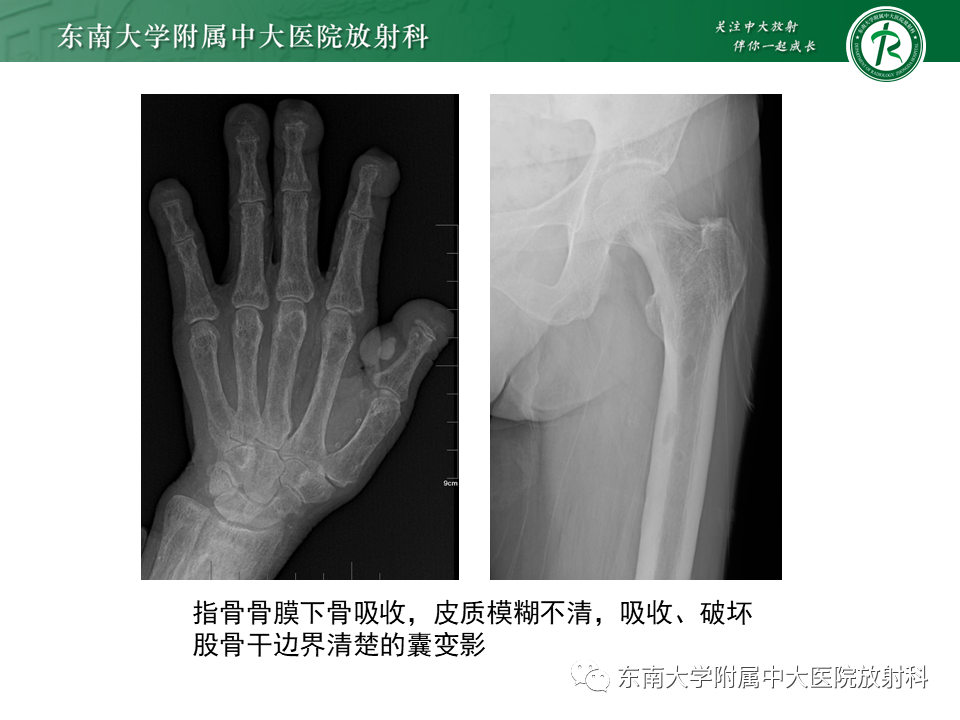 影像PPT - 【PPT】肾性骨营养不良-19 影像PPT - 【PPT】肾性骨营养不良-19