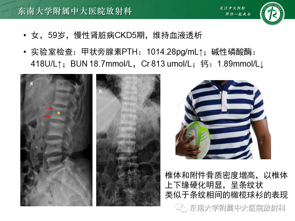 影像PPT - 【PPT】肾性骨营养不良-22 影像PPT - 【PPT】肾性骨营养不良-22