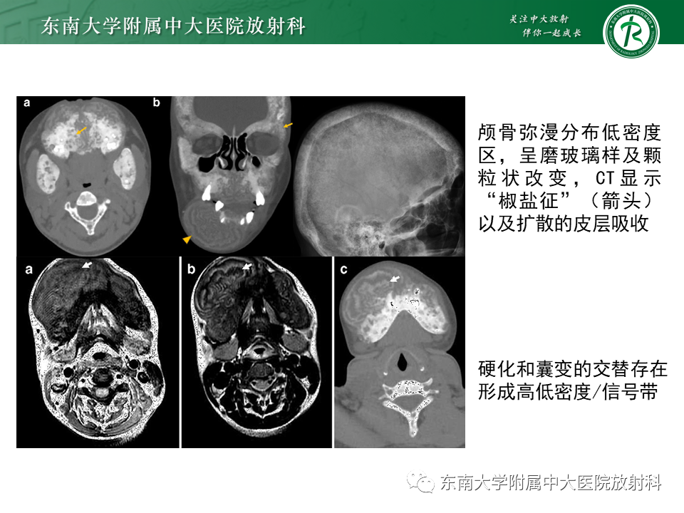 影像PPT - 【PPT】肾性骨营养不良-20 影像PPT - 【PPT】肾性骨营养不良-20