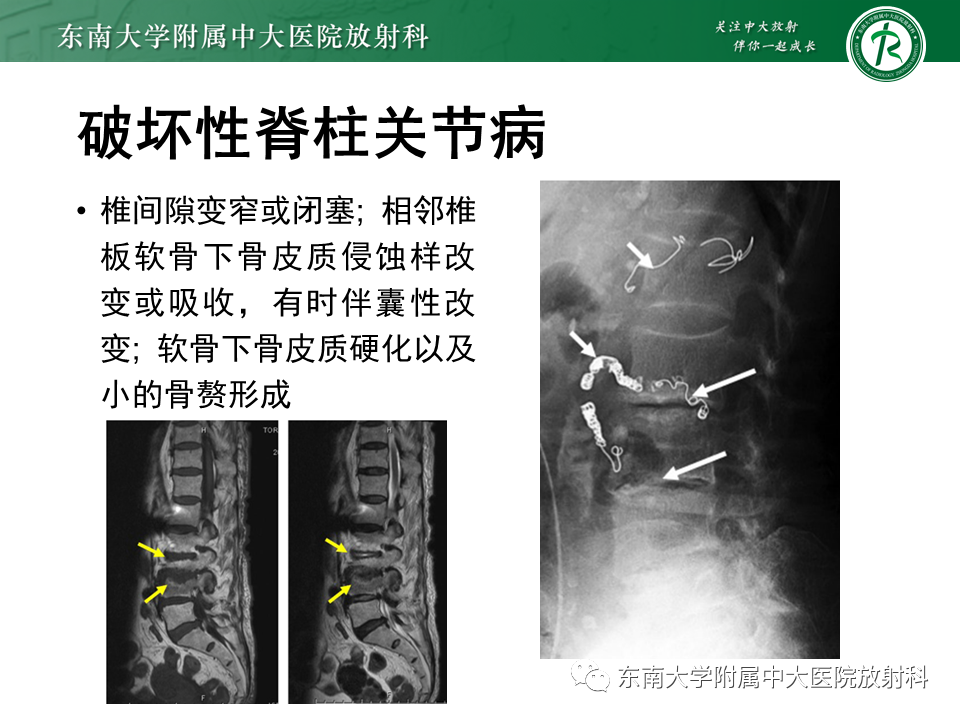 影像PPT - 【PPT】肾性骨营养不良-25 影像PPT - 【PPT】肾性骨营养不良-25