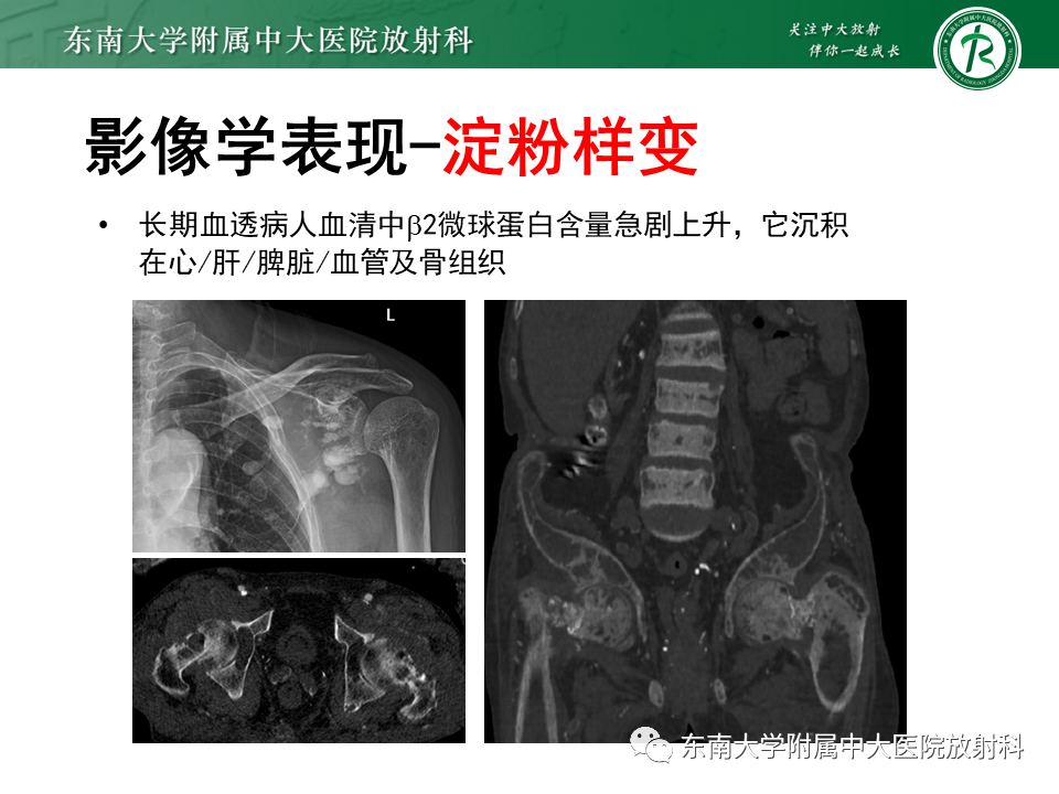 影像PPT - 【PPT】肾性骨营养不良-27 影像PPT - 【PPT】肾性骨营养不良-27