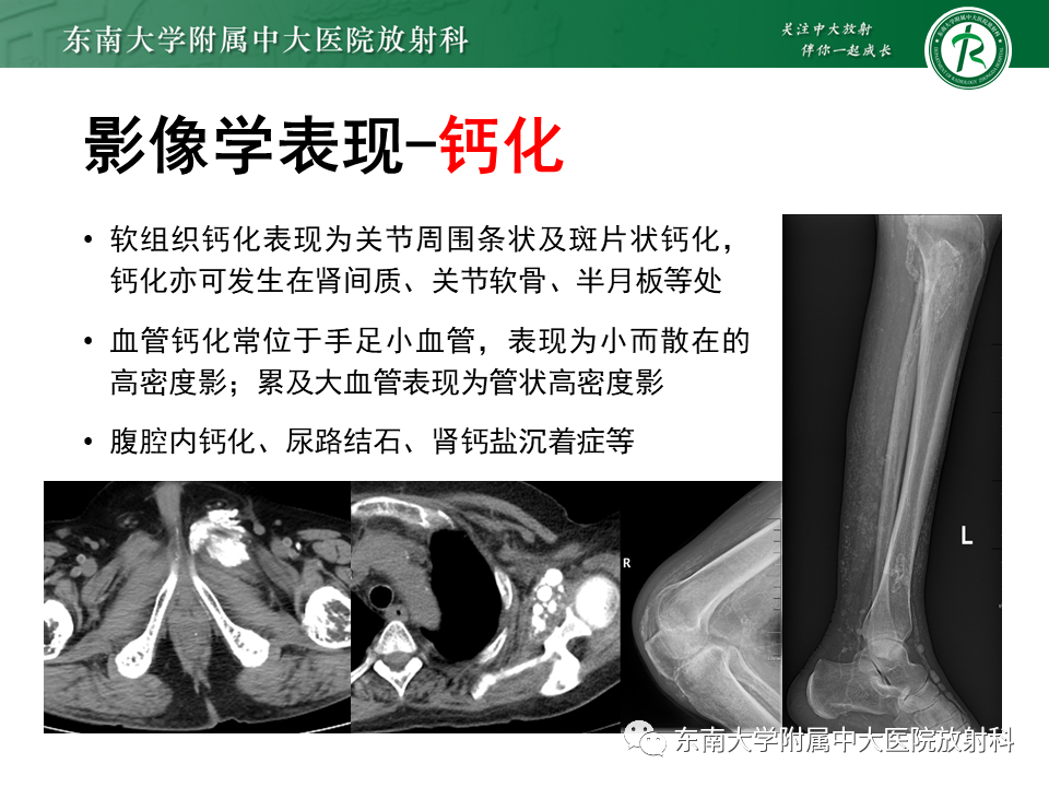 影像PPT - 【PPT】肾性骨营养不良-28 影像PPT - 【PPT】肾性骨营养不良-28