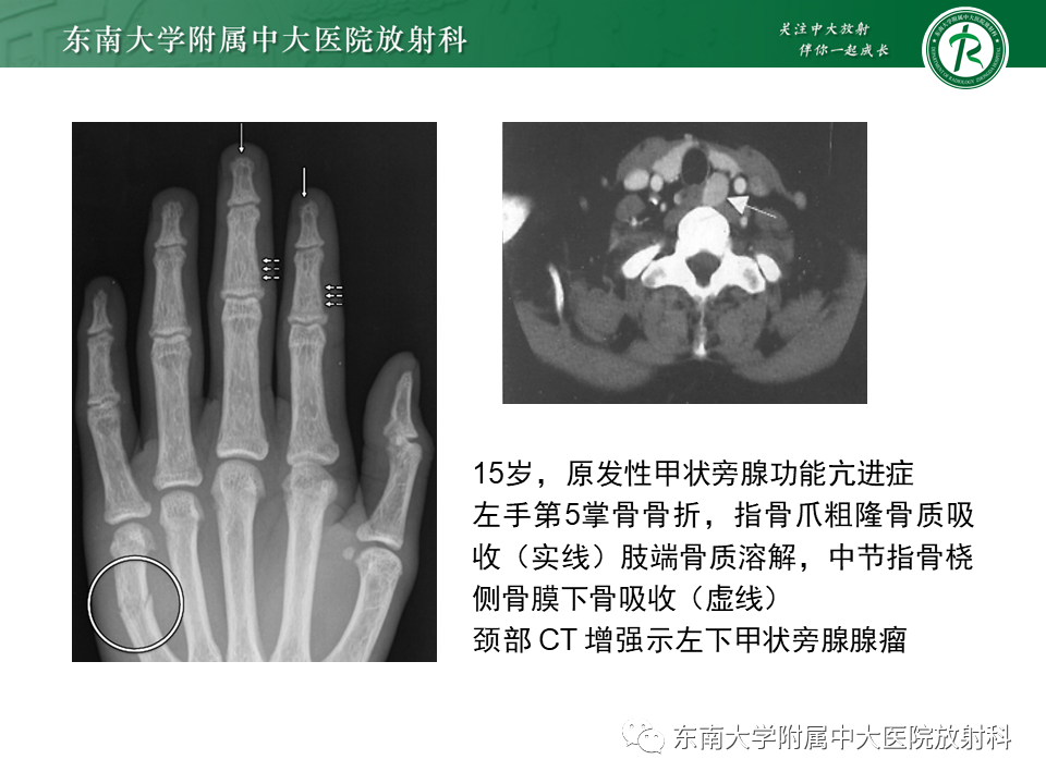 影像PPT - 【PPT】肾性骨营养不良-31 影像PPT - 【PPT】肾性骨营养不良-31