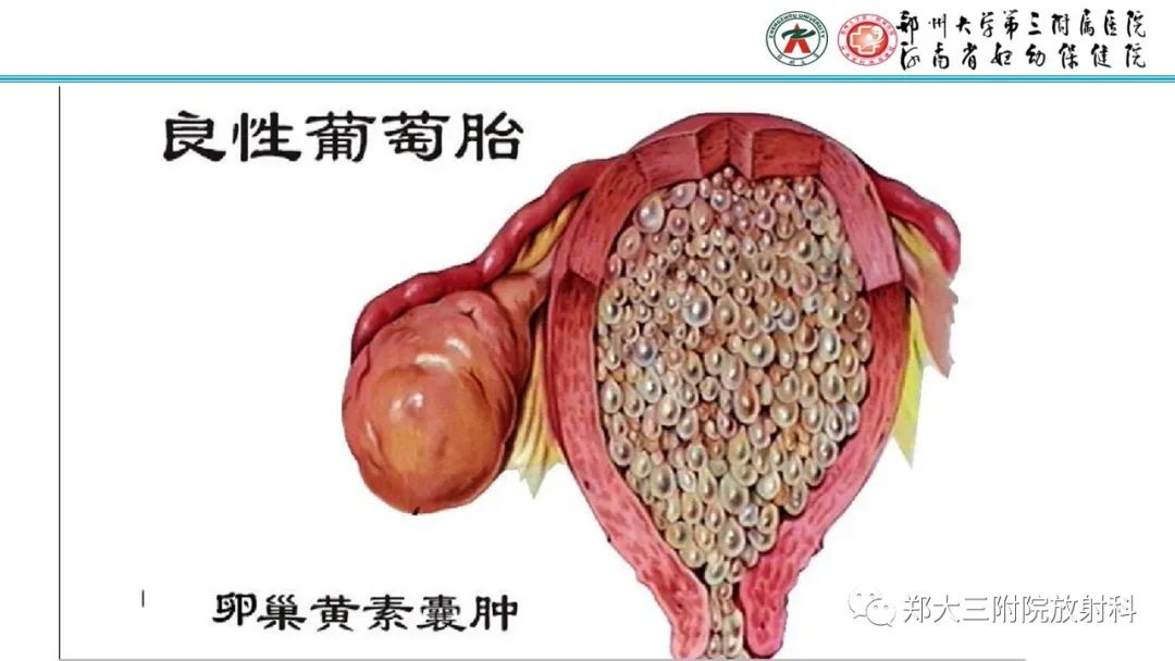 影像PPT - 【PPT】滋养细胞疾病的影像诊断-10