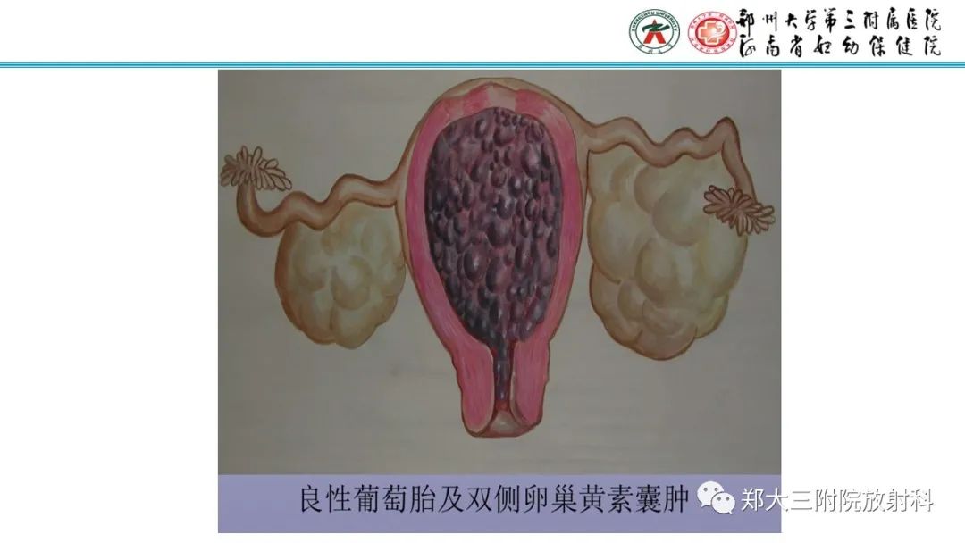 影像PPT - 【PPT】滋养细胞疾病的影像诊断-12