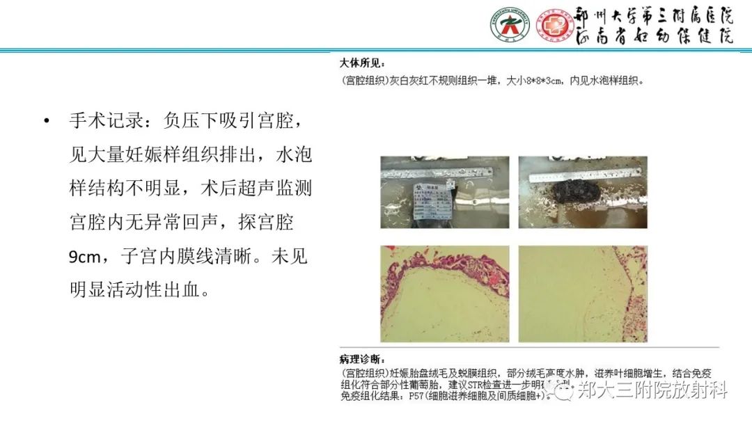 影像PPT - 【PPT】滋养细胞疾病的影像诊断-20
