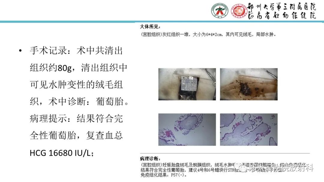 影像PPT - 【PPT】滋养细胞疾病的影像诊断-23