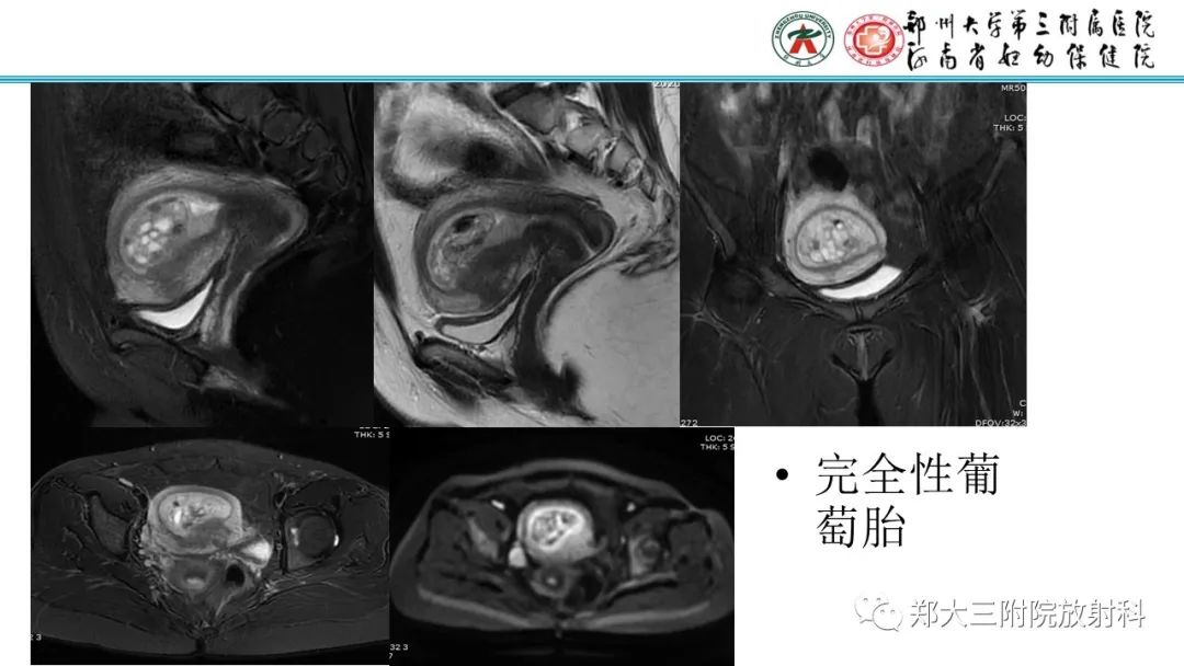 影像PPT - 【PPT】滋养细胞疾病的影像诊断-22