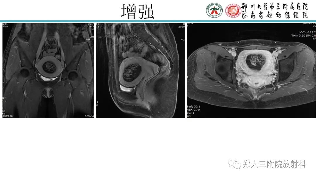 影像PPT - 【PPT】滋养细胞疾病的影像诊断-26
