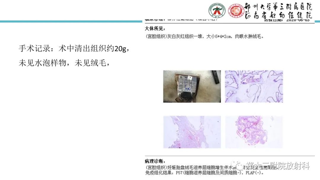 影像PPT - 【PPT】滋养细胞疾病的影像诊断-27