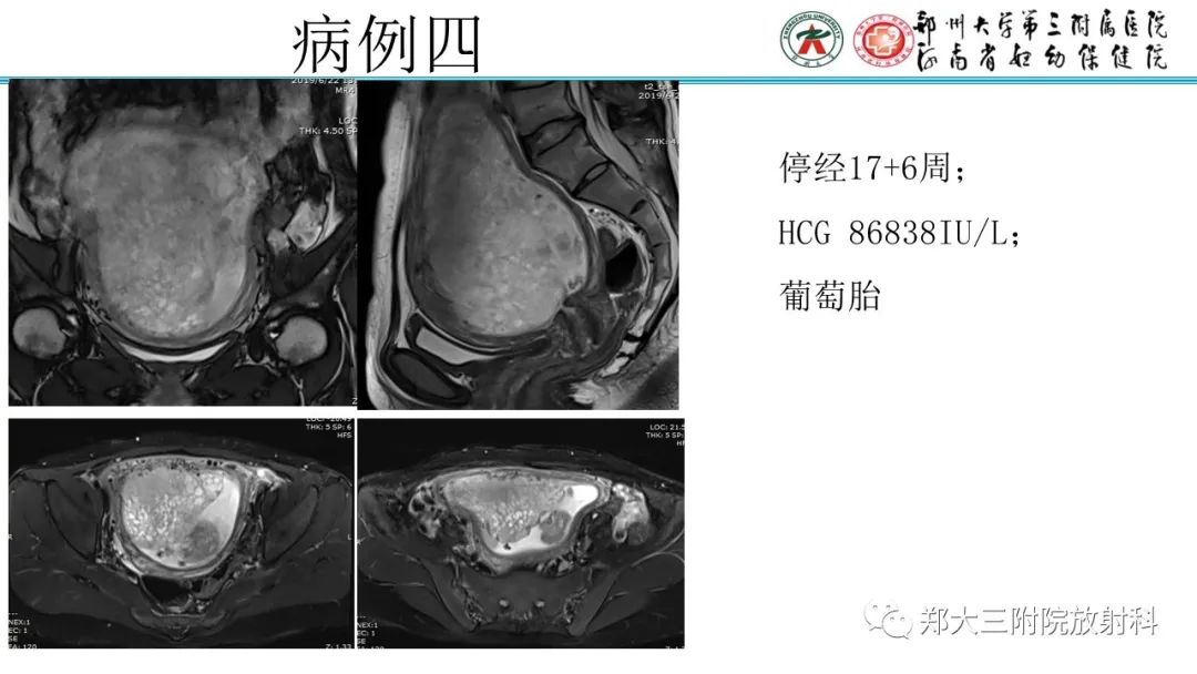 影像PPT - 【PPT】滋养细胞疾病的影像诊断-28