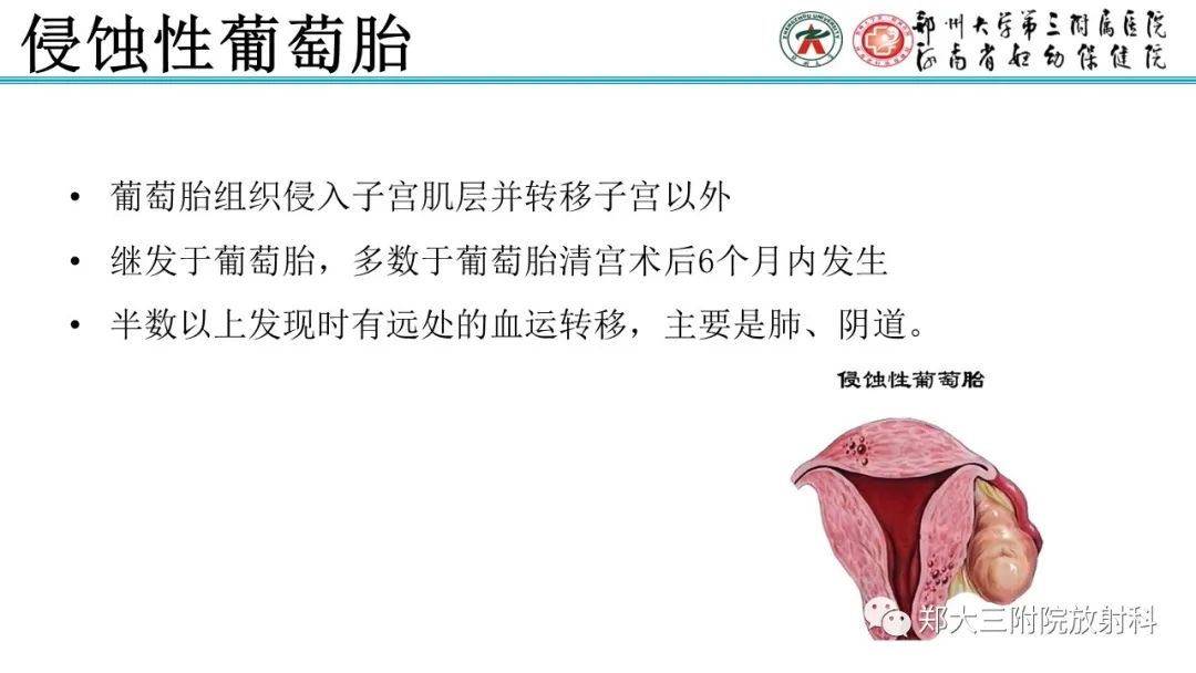 影像PPT - 【PPT】滋养细胞疾病的影像诊断-32
