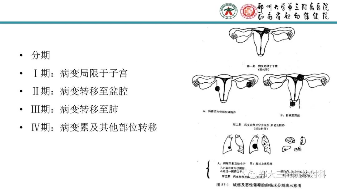 影像PPT - 【PPT】滋养细胞疾病的影像诊断-43